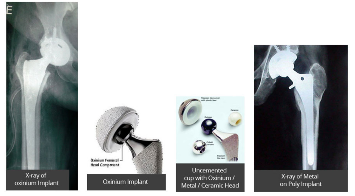 OXINIUM-TOTAL-HIP-REPLACEMENT-left