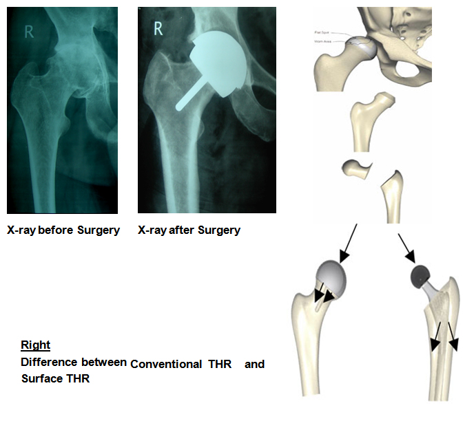 SURFACE-TOTAL-HIP-REPLACEMENT-left