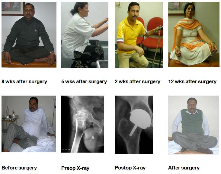 SURFACE-TOTAL-HIP-REPLACEMENT-right