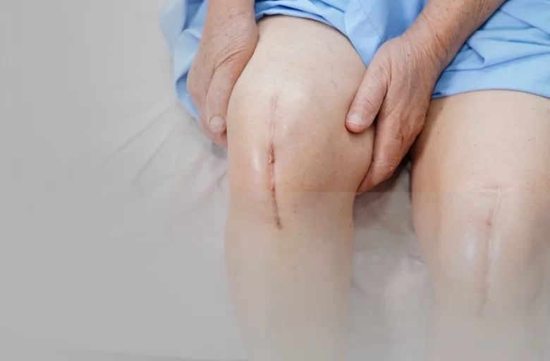 What is Osteoarthritis?