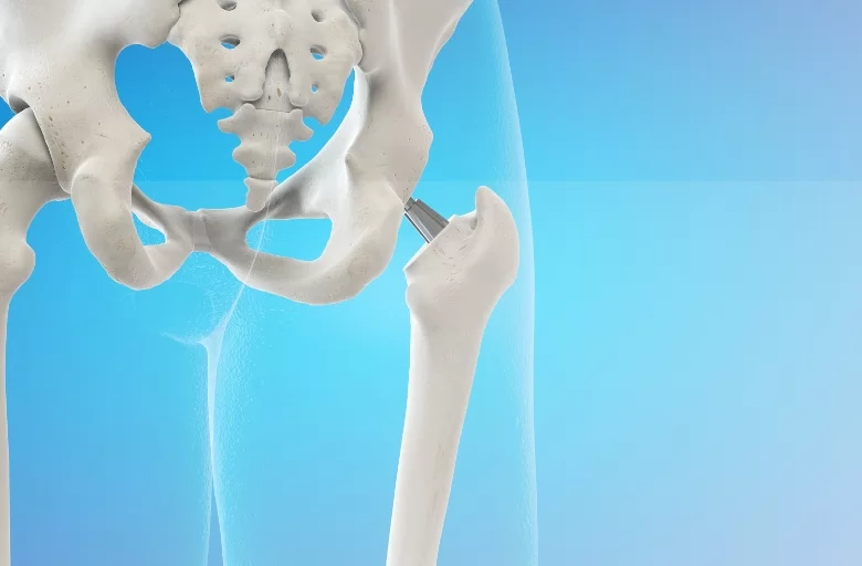 What is Osteoarthritis?