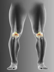 Joint Replacement Surgery in Delhi