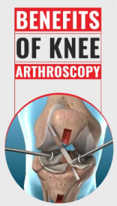 Benefits of Early Knee Arthroscopy