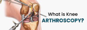 What Is Knee Arthroscopy?