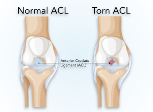 ACL injury treatment in Delhi